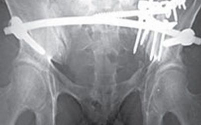 Tratamento de lesões instáveis do anel pélvico com um fixador interno anterior e fixação posterior: Serie clínica inicial
