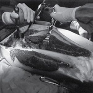 A cirurgia precoce dos pacientes com fratura da extremidade proximal do fêmur em uso de Clopidogrel é segura? Revisão sistemática, metanálise e meta-regressão