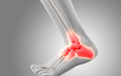 TRAUMA explica: Como funciona a artroplastia no tornozelo?